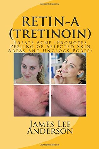 Download RETIN-A (Tretinoin): Treats Acne (Promotes Peeling of Affected Skin Areas and Unclogs Pores) - James Lee Anderson file in ePub